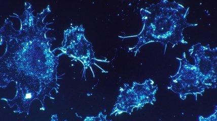 Раковые клетки способны соединятся с нейронами головного мозга