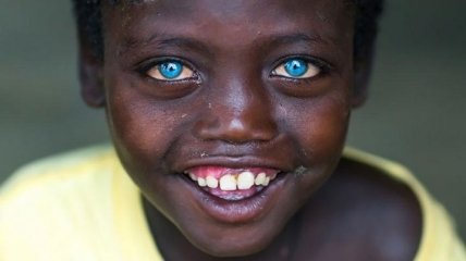 Мальчик с невероятно красивым глазами, подаренными ему болезнью (Фото)