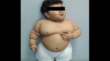 Невероятно: 2-летний малыш весил 33 килограмма 