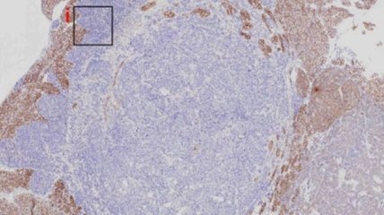 Исследователи остановили онкогенез у мышей