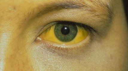 Одним из показательных симптомов заболевания является сильное пожелтение глаз