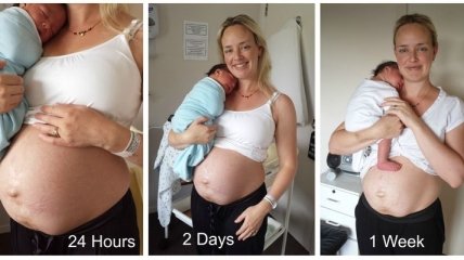 Новоиспеченная мама показала как менялось ее тело в течение 14 дней после родов (Фото) 