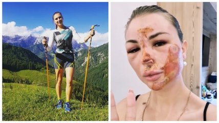 Анна Кривонос травмировала лицо в результате падения на тренировке