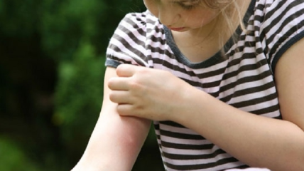 Зуд при укусе комаров: как облегчить состояние ребенка