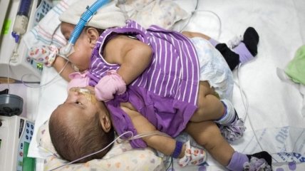 В Техасе врачи разделят сиамских близнецов-девочек (ФОТО)