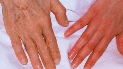 Холодные руки и ноги могут быть сигналом опасной болезни