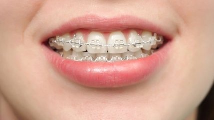 Способы выравнивания зубов 