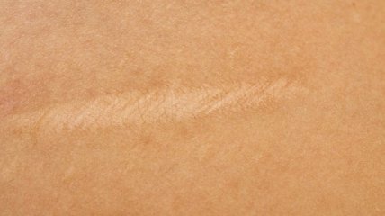 Ультразвук способствует лечению шрамов