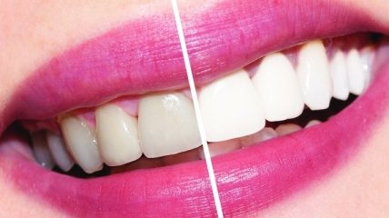 Ученые назвали основную причину "плохих" зубов 