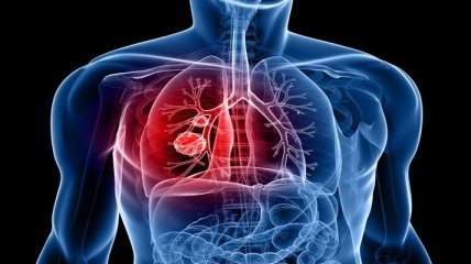 Первые признаки туберкулеза легких, которые нельзя игнорировать