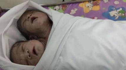 Уникальный случай: в Мьянме родился ребенок с двумя головами