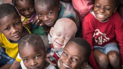 Чужой среди своих: как живут альбиносы в Танзании (Фото)