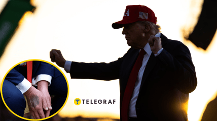 Розмови про гематоми Трампа не вщухають