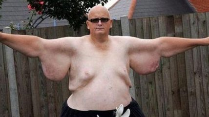 Самый толстый мужчина планеты сбросил 292 кг