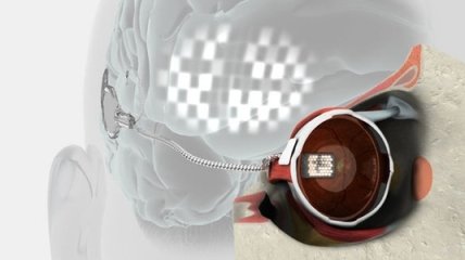 Впервые в истории имплантирован искусственный бионический глаз