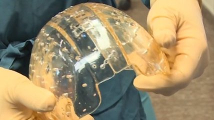 Ученые трансплантировали череп, напечатанный на 3D-принтере