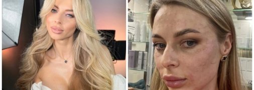 Девушка получила ожоги на лице