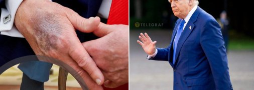 Язвы на руках Трампа