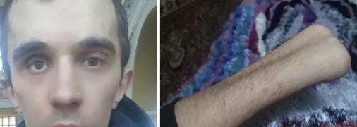 Нет руки и глаза, но военкомат о нем не забыл: почему жителя Сумщины призывают уже второй раз