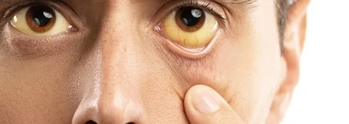 Желтизна на глазах свидетельствует о заболевании печени