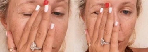 На лице у Собчак заметна сильная пигментация