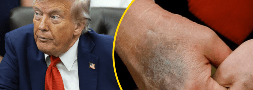 Дональд Трамп прикриває синець