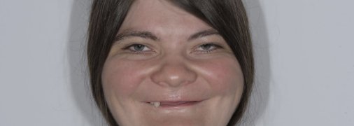 Ольга Мацик в 32 года имела всего 3 зуба