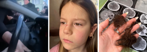 Избиение закончилось сотрясением мозга у матери и гематомами у ее дочери