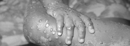 Жителей Европы начала поражать смертельно опасная инфекция: симптомы и фото