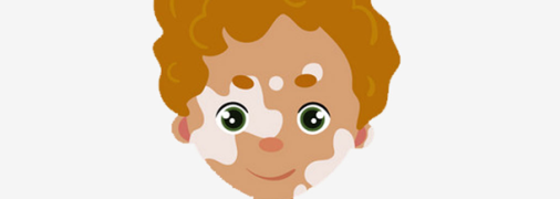 Витилиго у детей: симптомы, причины, лечение